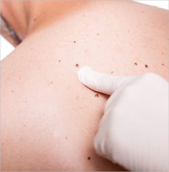 Vorsorgeuntersuchung Hautarzt Krems