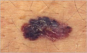 Melanom mittleres Stadium