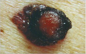 Melanom fortgeschrittenes Stadium