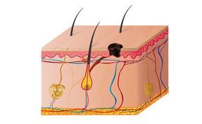 Hautarzt-Krems-Melanom-2
