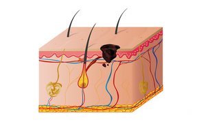 Hautarzt-Krems-Melanom-3