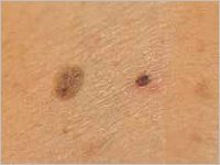 Informationen zu den Formen des Hautkrebs