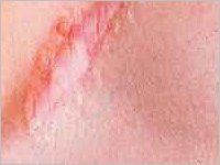 Seltene Hauttumore - Dr. Schätz-Hautarzt-Krems